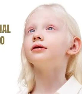 13 DE JUNIO: DIA DELA SENSIBILIZACION SOBRE EL ALBINISMO