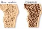 20 DE OCTUBRE: DIA MUNDIAL DE LA OSTEOPOROSIS