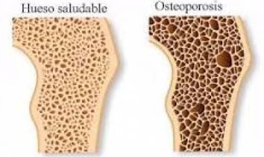 20 DE OCTUBRE: DIA MUNDIAL DE LA OSTEOPOROSIS