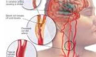 29 DE OCTUBRE DE 2023: DIA MUNDIAL DE LUCHA CONTRA EL ACV