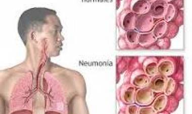 12 DE NOVIEMBRE: DIA MUNDIAL CONTRA LA NEUMONIA