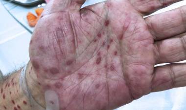 HAY QUE CUIDARSE...!!!