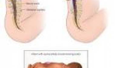 21 DE NOVIEMBRE: DIA MUNDIAL DE LA ESPINA BIFIDA