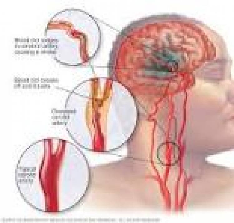 29 DE OCTUBRE DE 2023: DIA MUNDIAL DE LUCHA CONTRA EL ACV
