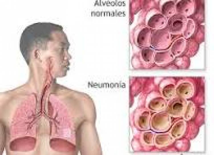 12 DE NOVIEMBRE: DIA MUNDIAL CONTRA LA NEUMONIA