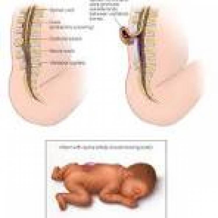 21 DE NOVIEMBRE: DIA MUNDIAL DE LA ESPINA BIFIDA