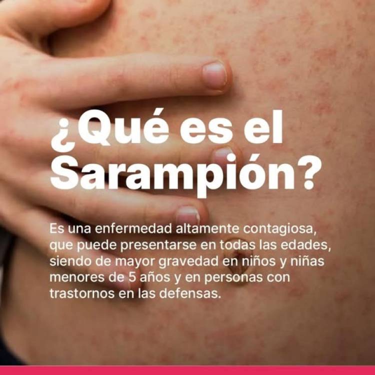 SAMCO RUFINO: SARAMPION